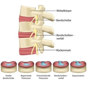 Knorpelverlust führt zu Gelenkverschleiß